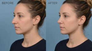 rhinoplasty recovery