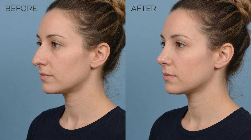 rhinoplasty recovery