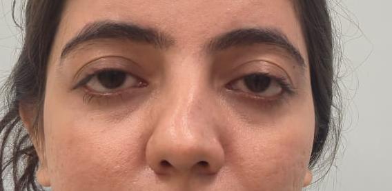 Rhinoplasty Surgery in Karachi