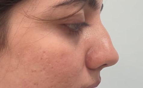 Rhinoplasty Surgeon