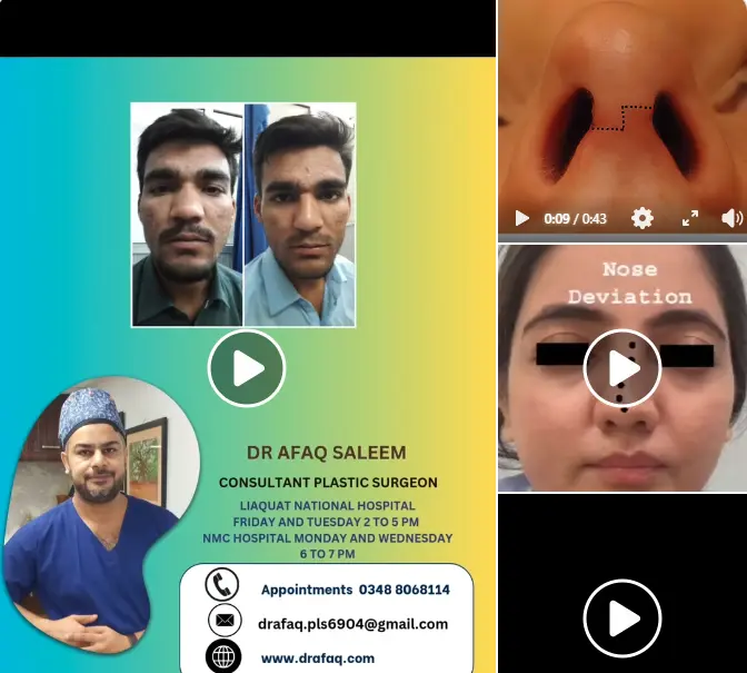 Rhinoplasty Dilemma