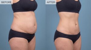 tummy tuck surgery