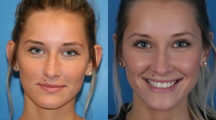 Otoplasty Surgery Before and After